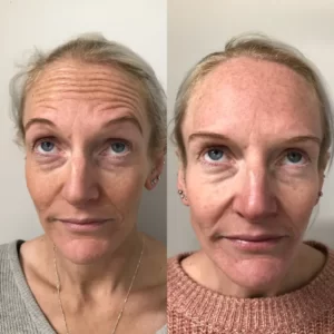 Before-and-after-Botox-Penrith-Blue-Mountains