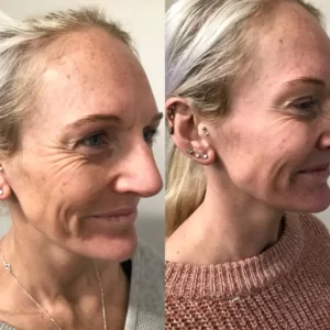 Crows-feet-botox-Penrith-before-and-after