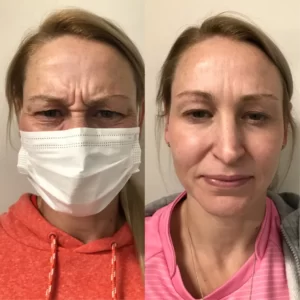 Frown-lines-botox-Blaxland-before-and-after
