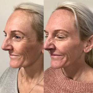 Smile-lines-botox-Penrith-before-and-after